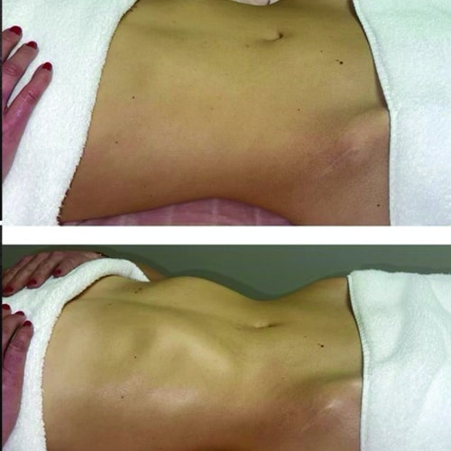 Before and after treatment 2